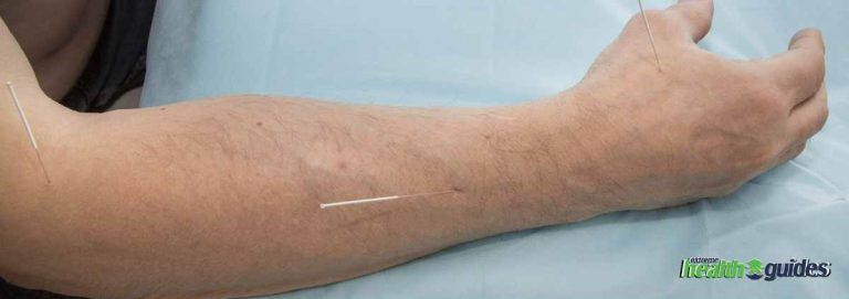 Acupuncture For Neuropathy: Can It Really Help Nerve Pain?