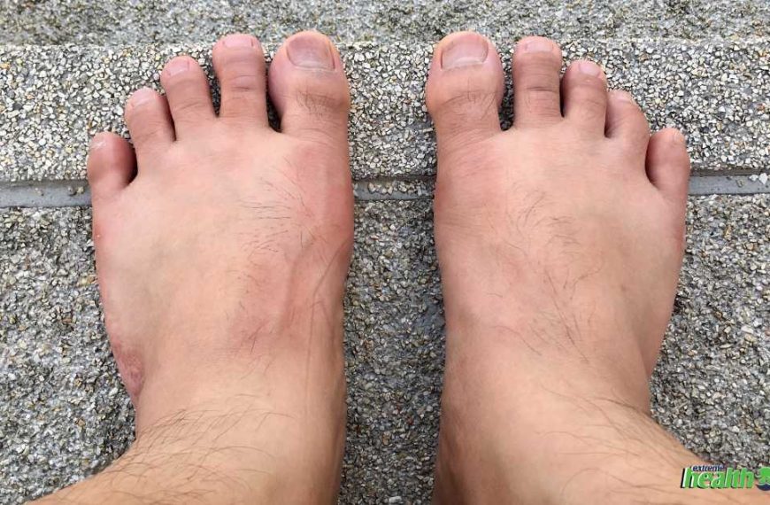 Signs and Symptoms of Diabetic Foot: What are the Causes?