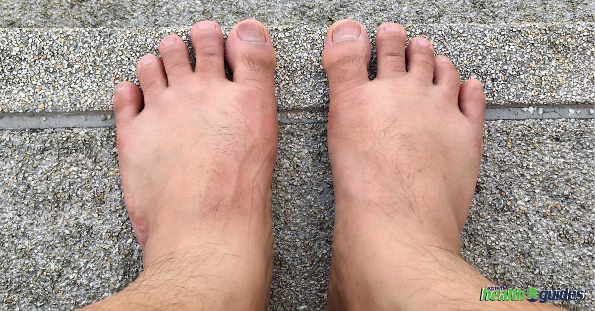 Diabetic Foot Symptoms Featured Image