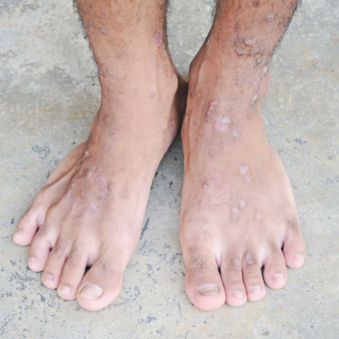a human's Diabetes Affected Feet