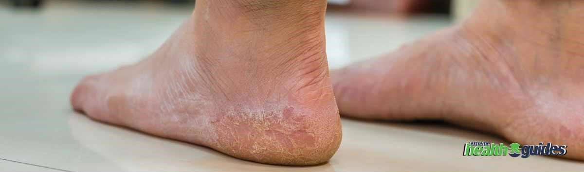a human's Diabetic Foot